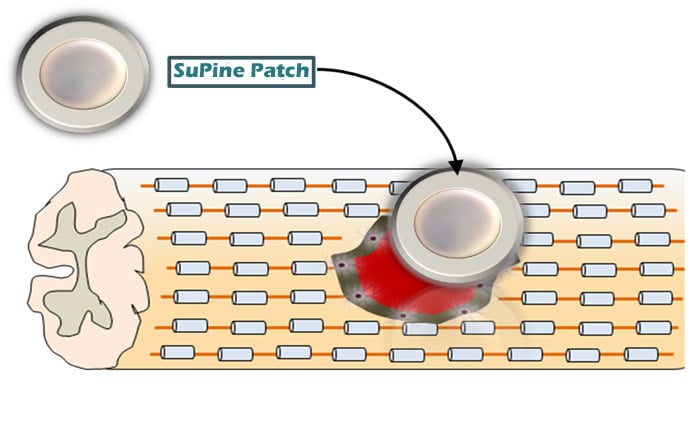 SuPine Patch
