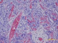 Angiogenesis 
