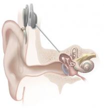 cochlear-implants