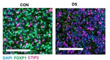 The panels above show microscopic images of different cell types in fetal human brain tissue from healthy (CON) and Down syndrome (DS) samples. The green cells represent a type of neuron that is greatly reduced in individuals with Down syndrome. 