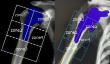 shoulder replacement dual x-ray scans