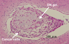 The cancer stem cells cultured on the DN gel formed a tumor when injected into mice brain.