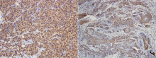 PD-L1 immunohistochemical staining in typical oral malignant melanoma (left) and squamous cell skin cancer (right)