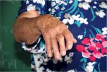 Rheumatoid Arthritis (CC BY-NC 2.0 Leides Moura)