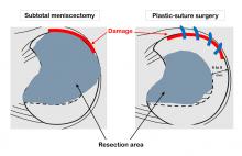 Comparing surgeries for repairing a torn meniscus in young patients