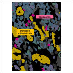 Curbing the neutrophil surge: new treatment offers hope for autoimmune diseases