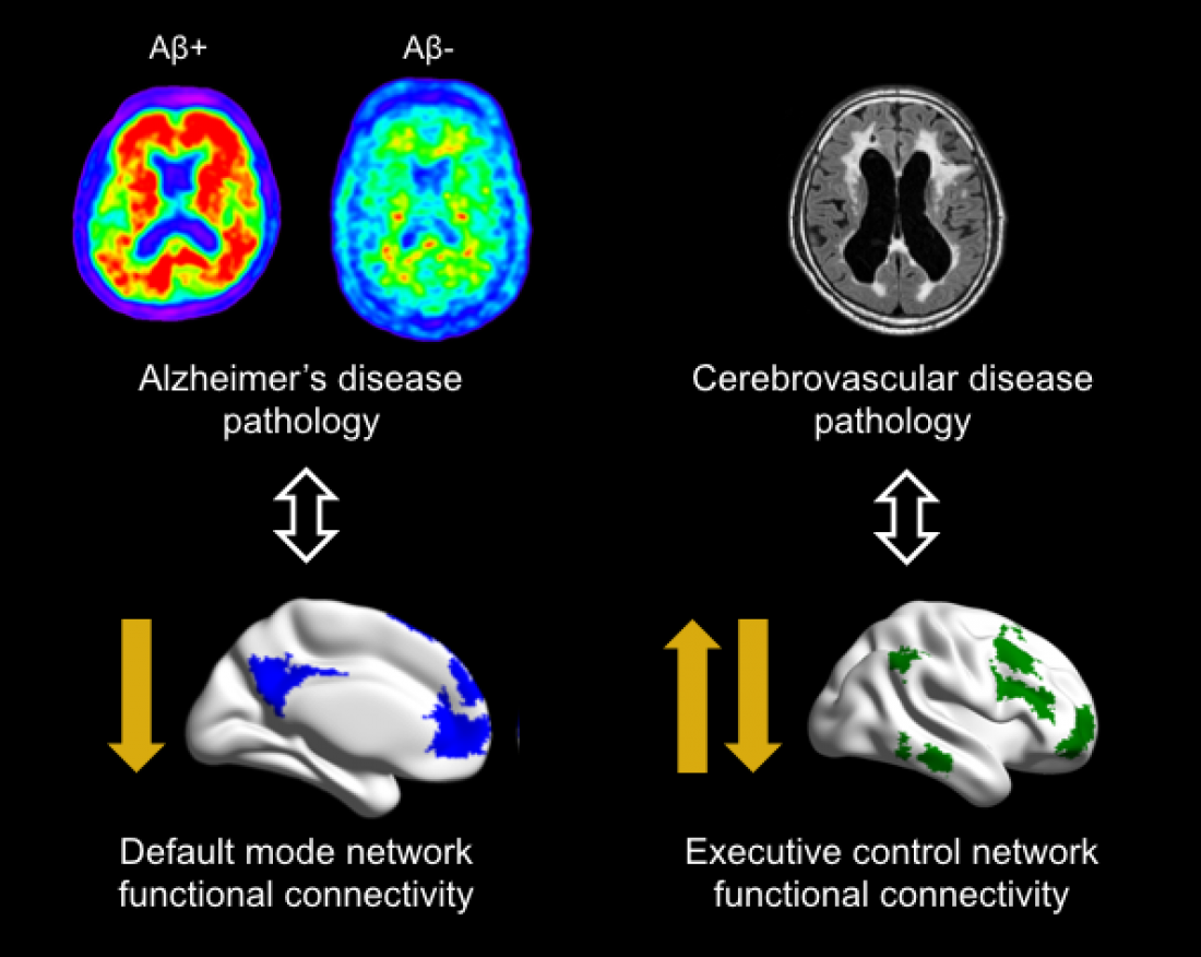 Changes in functional brain network connectivity may help early ...