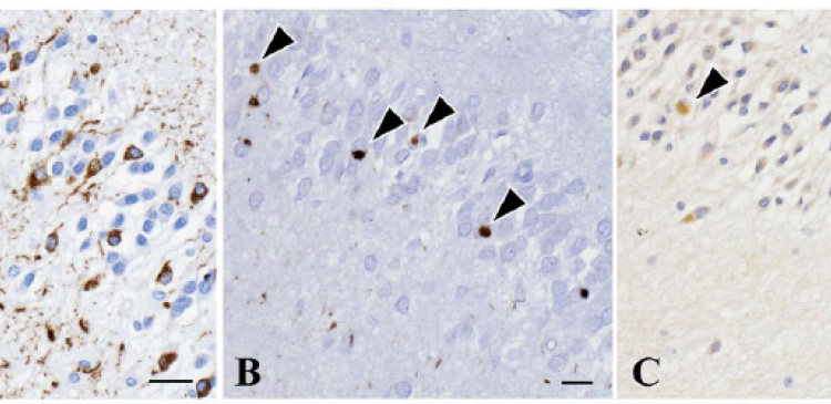 Tau proteins accumulated in the brain of a patient with PSP-like symptoms.