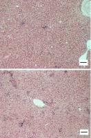 liver granuloma