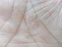 psoriasis