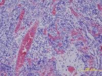 Angiogenesis 