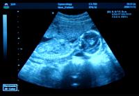 Sonography