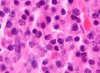 Micrograph of haematological cancer cells