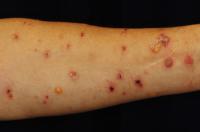Non-inflammatory bullous pemphigoid (BP) seen in the type 2 diabetes patient who are administered with DPP-4 inhibitor.