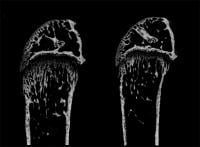 Reversing severe bone loss