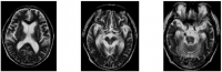 MRI analysis of a patient with PSP-like symptoms showed severe atrophy of the bilateral hippocampus, mesencephalic tegmentum, cerebellum, and brainstem. 
