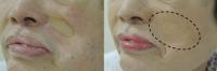 Cosmetically smoothing over visible facial scars