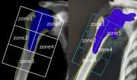 shoulder replacement dual x-ray scans