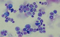Leukaemia cells with the BIM variation under a microscope