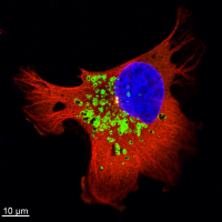 Lysosomes in a breast cancer cell.
