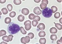 Adult T-cell leukemia/lymphoma. The leukemia cells have irregular nuclei which are deeply convoluted (deep violet). (Photo: Peter Maslak/American Society of Hematology).