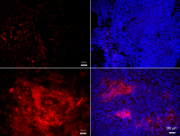 Oxidized-LDL accumulates (left column) in malignant tumors (bottom) much more than in non-malignant ones (top). This attracts neutrophils (right column, red) to malignant tumors (bottom), but not to non-malignant ones.