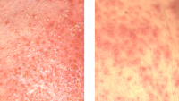 A scoring system has been developed to help distinguish between two diseases.