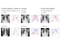  Chest radiographs and average saliency maps