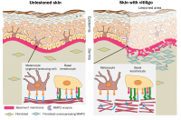 A graphical representation illustrates what might be occurring in undamaged and damaged skin.