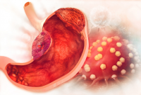 stomach cancer